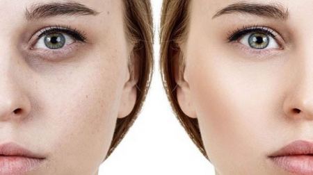 الهالات السوداء تحت العين أسبابها وعلاجها