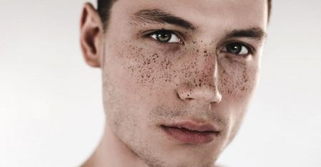 النمش في الوجه وأفضل طريقه لعلاج النمش
